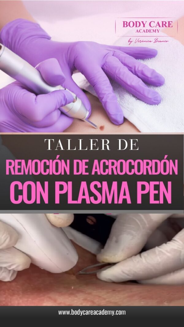 Remoción de Acrocordones<br>con PLASMA PEN